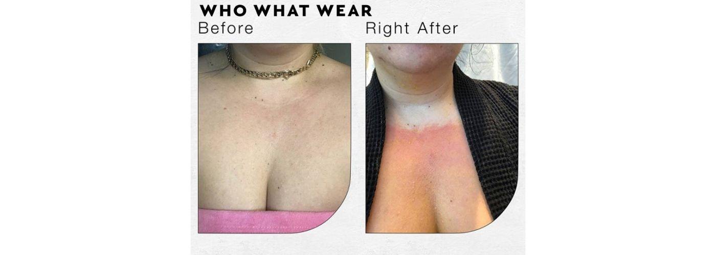 This Is What I Did to Undo the Years of Sun Damage on My Cleavage - Emerage Cosmetics